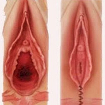Cirurgia para Flacidez na Vagina